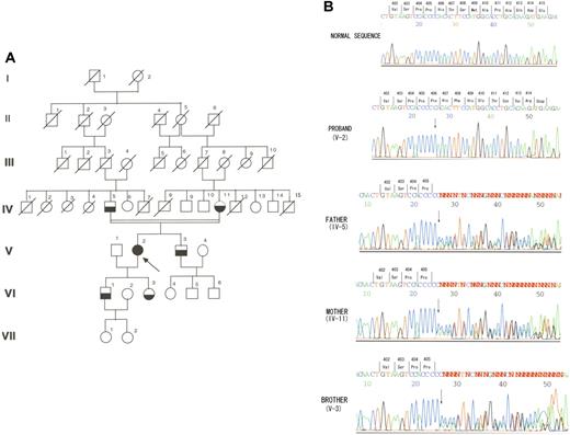Figure 1. A novel frameshift mutation in exon 10 of the kininogen gene found in a Japanese family with isolated HK deficiency. (A) Pedigree of the family with isolated HK deficiency. Arrow indicates the proband; filled symbol, homozygous isolated HK deficiency; half-filled symbols, heterozygous isolated HK deficiency; symbols with diagonal line, deceased family members; and open symbols, unexplored subjects. (B) Identification of a base-pair insertion within exon 10 of the kininogen gene. The proband exhibited a homozygous base pair insertion of a cytidine at nucleotide position 1217 in exon 10. The proband's father, mother, and brother were heterozygous for the same defect.