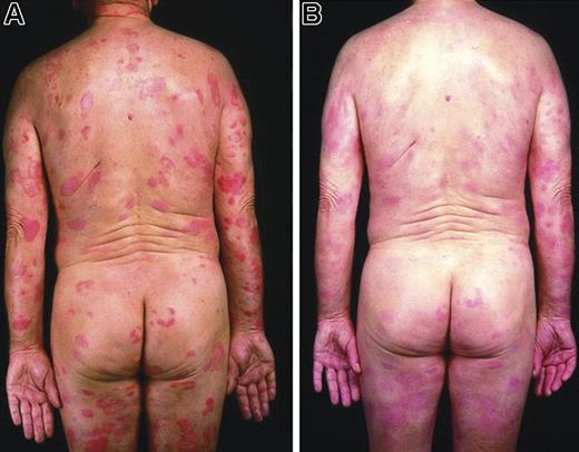 Figure 2. Clinical improvement in a patient with early-stage (IB) mycosis fungoides. (A) Baseline. (B) Week 4.