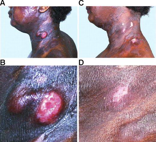 Figure 3. Complete clearance of a tumor in a patient with advanced-stage mycosis fungoides (stage IVA). (A-B) Baseline. (C-D) Cleared tumor at week 8.