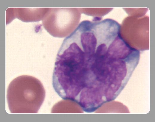 Peter Maslak, Memorial Sloan-Kettering Cancer Center. / This high-power view of the peripheral blood smear of a patient with adult T-cell leukemia/lymphoma contains a characteristic cloverleaf, or “flower,” cell. This malignant lymphoid cell has a pleomorphic nucleus with deeply basophilic cytoplasm. These cells typically express CD25 but lack CD7.