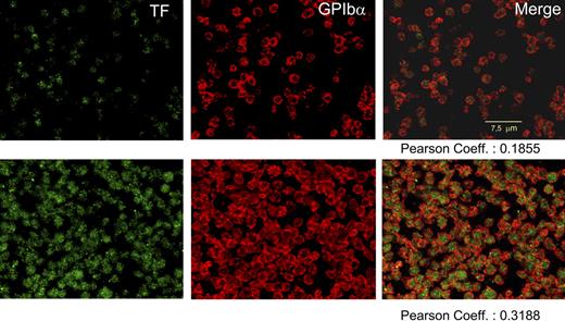Figure 3. Confocal immunodetection of TF and GPIbα in human, nonpermeabilized platelets. After fixation, blockade of nonspecific binding sites, and overnight incubation at 4°C, EDTA-PGE1 platelets were immunolabeled with polyclonal anti-TF and/or α-GPIbα (α-CD42b, clone SZ2; Immunotech, Westbrook, ME). For TF, incubation with rabbit anti-sheep IgG was required before incubating with the appropriate FITC antibody. Alexa 555 (Invitrogen) was used to visualize the GPIbα. Top row shows, from left to right: nonstimulated, freshly prepared platelets labeled for TF, GPIbα, and merge imaging. Bottom row shows an aliquot of the same sample stimulated with TRAP and collagen for 2 hours. A striking enhancement of both labels is noticed with a significant increase in the colocalization of both proteins. No leukocytes were observed in all the experiments.
