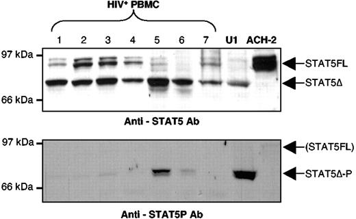 Figure 1. Expression and activation of STAT5 isoforms in PBMC of HIV-positive individuals and in the chronically infected U1 cell line. Expression of both STAT5FL and STAT5Δ (upper panel) and of constitutively activated STAT5Δ in WCE of PBMC from HIV-positive individuals (lower panel) as detected by Western blotting using specific anti-STAT5 and antiphosphorylated STAT5 Ab, respectively. PBMC from all HIV-positive individuals studied are characterized by the dominant (patient nos. 1, 2, 3, 4, and 7) or exclusive (patient nos. 5 and 6) presence of STAT5Δ (upper panel). Variable levels of constitutive activation of STAT5Δ were detected by using anti-phospho-STAT5 (lower panel). Exclusive expression of either STAT5Δ or STAT5FL was detected in U1 and ACH-2 cells, respectively (upper panel). GM-CSF stimulation (15 minutes) of U1 cells led to the phosphorylation of STAT5Δ (U1, lower panel), whereas no stimuli were identified as capable of activating STAT5FL in ACH-2 cells (see text).