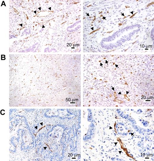 Figure 5. TIE2 immunohistochemistry of human cancer cryosections. After TIE2 immunostaining, the sections were counterstained with hematoxylin and eosin and shown at lower (left) or higher (right) magnification. (A) Colon adenocarcinoma. In addition to vascular ECs (arrowheads), TIE2 staining highlights the presence of stromal mononuclear elements morphologically consistent with monocytes (arrows). These cells appear inhomogeneously distributed, with foci of high density (arrows). (B) Gastric undifferentiated adenocarcinoma. Many TIE2+ mononuclear cells are found in the tumor stroma (arrows). Blood vessels are indicated by arrowheads. (C) Pancreatic adenocarcinoma. The majority of TIE2+ structures in the left panel are blood vessels (arrowheads). An individual TIE2+ mononuclear cell is shown (arrow) in the right panel.
