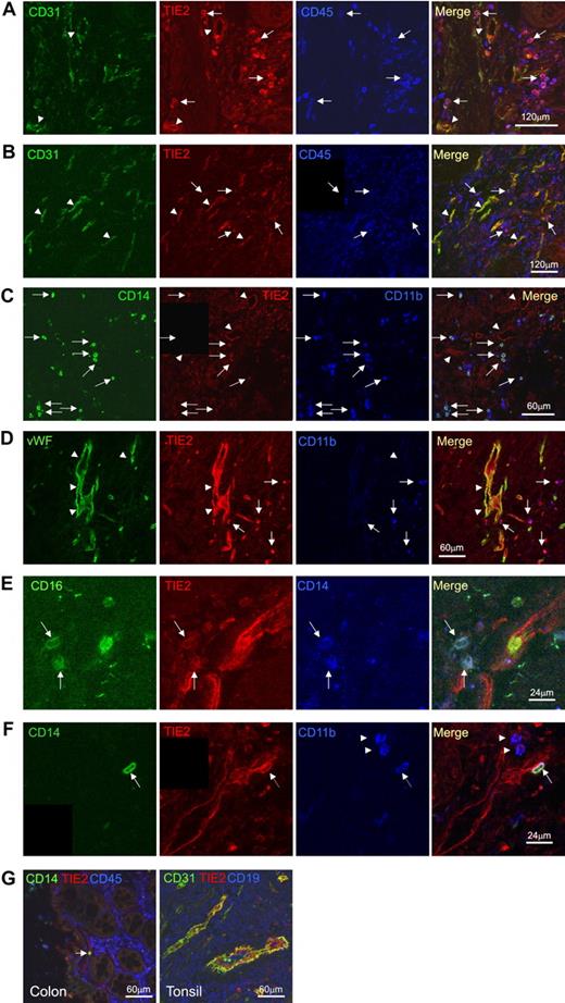 Figure 6. Confocal immunofluorescence analysis of human cancer sections confirms the presence of TIE2+CD45+CD14+ tumor-infiltrating monocytes. (A) Colon adenocarcinoma analyzed for CD31 (green), TIE2 (red), and CD45 (blue). Confocal planes are shown individually and after merging. Several TIE2+CD45+CD31− hematopoietic cells (merge of red and blue giving purple; arrows) are found within the tumor stroma. Note that TIE2 is expressed by vascular ECs (merge of green and red giving yellow; arrowheads), which are TIE2+CD45−CD31+. (B) Gastric adenocarcinoma analyzed for CD31 (green), TIE2 (red), and CD45 (blue). Some TIE2+CD45+CD31− hematopoietic cells are found in the tumor stroma (arrows) together with TIE2+CD45−CD31+ tumor blood vessels (arrowhead). Scale bars as indicated. (C) Colon adenocarcinoma analyzed for CD14 (green), TIE2 (red), and CD11b (blue). Several TIE2+CD14+CD11b+ monocytes (arrows) are found within the tumor stroma. Note TIE2 expression by TIE2+CD14−CD11b− vascular ECs (arrowheads). (D) Gastric adenocarcinoma analyzed for VWF (green), TIE2 (red), and CD11b (blue). Arrowheads indicate TIE2+CD11b+VWF− monocytes. (E) Pancreatic adenocarcinoma analyzed for CD16 (green), TIE2 (red), and CD14 (blue). High-magnification photos show the presence of TIE2+CD16+CD14+ monocytes (arrows) in the tumor stroma. (F) Colon adenocarcinoma analyzed for CD14 (green), TIE2 (red), and CD11b (blue). A triple-positive CD14+TIE2+CD11b+ TEM with peri-endothelial localization is indicated by the arrow. Note the presence of CD14−TIE2−CD11b+ inflammatory cells (arrowheads). Scale bars as indicated. (G) TIE2 expression in nonneoplastic tissues is restricted to vascular ECs. Nonneoplastic colon mucosa adjacent to tumor tissue analyzed by confocal immunofluorescence staining of CD31 or CD14 (green), TIE2 (red), and CD45 (blue). Note that the lamina propria macrophages are CD14−TIE2−. A single CD14+TIE2− monocyte (arrow) is found within a TIE2+ blood vessel. Tonsil sections show that TIE2 expression (red) is restricted to CD31+ vascular ECs (green). CD19+ B cells are stained in blue. Scale bars as indicated.