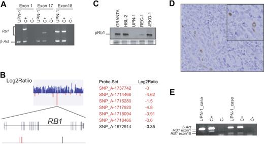 Figure 4. RB1 is inactivated in UPN-1 and in the original primary MCL. (A) Multiplex PCR amplifications of RB1 exons 1, 17, and 18 performed with genomic DNA from UPN-1 cells are shown. Although β-actin (β-act) was amplified in both UPN-1 and in the control (C+), only exon 18 of RB1 was amplified in UPN-1. (B) A section of the Log2Ratio graph corresponding to the 13q14 region generated by the CNAT application is showed. All SNPs are displayed in blue color indicating that the log2 ratio values were higher than 0. A zoom view of a small region containing negative log2 ratio values show that it correspond to the RB1 locus. Two maps are shown, one represents all RB1 exons by gray vertical lines, and the second represents the SNPs located in the region. In red are indicated the SNPs that are deleted with signal log2 ratio value lower than −1, and conserved SNPs are shown in black. (C) pRB1 expression was analyzed by Western blot in 5 cell lines. Equal amount of total protein was loaded in each lane. A section of the Coomassie staining gel is showed at the bottom. (D) Immunohistochemical staining of pRB1 in the primary tumor from which UPN-1 was established. Tumor cells are negative, whereas endothelial cells, considered as internal positive controls, showed positivity (inset). (E) A multiplex PCR reaction was designed to amplify exon 1 and 18 of RB1 together with β-actin. Both RB1 exons were amplified when we used a DNA control (C+), but when we used DNA extracted from the primary tumor from which the UPN-1 cell line was established (UPN-1 case) only the RB1 exon 18 was amplified.
