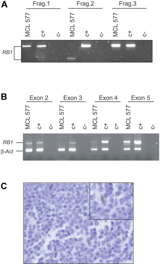 Figure 5. RB1 is inactivated in primary MCL. (A) Three of 8 PCR fragments designed to amplify the full-length RB1 cDNA are shown. Fragment 2, involving exon 2, 3, 4, and 5, amplified from a primary MCL (MCL 577), was shorter than the one amplified from the control (C+). (B) Genomic DNA from this primary MCL (MCL 577) and normal tissue (C+) were used in a multiplex PCR reaction in order to amplify exon 2, 3, 4, and 5 of RB1 together with β-actin. Only exons 2 and 5 were amplified in the primary MCL (MCL 577). (C) Immunohistochemical analysis of pRB1 in the primary tumor (MCL 577). A number of normal cells were positively stained (inset), but the tumor cells were negative.