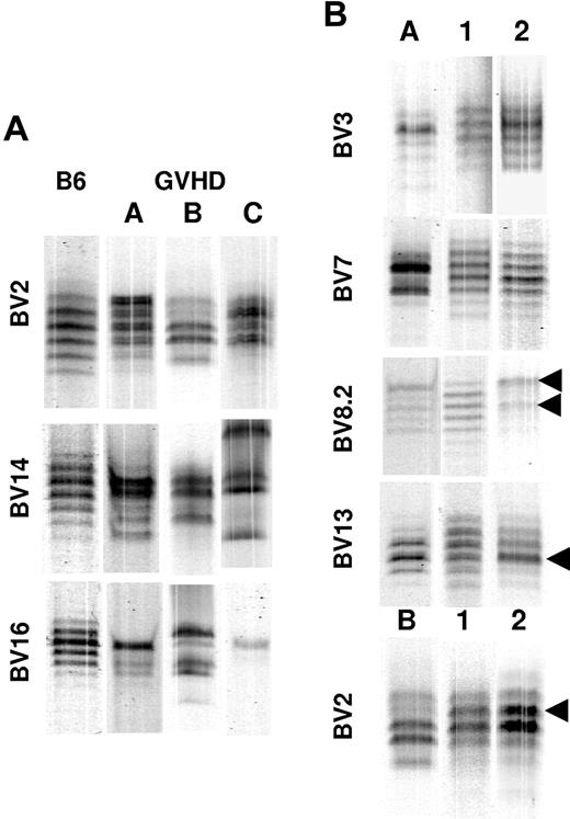Figure 3. Splenic T cells from mice undergoing GVHD are able to regenerate complex T-cell repertoires in secondary hosts. Lethally irradiated (1100 cGy) AKR mice were transplanted with Rag-1 BM (5 × 106) and a spleen cell-adjusted dose of 5 × 105 T cells obtained 19 to 29 days after BMT from B6→AKR chimeras as in Figure 1. Spleen cells from individual chimeras were each then transplanted into 2 to 3 secondary AKR hosts. AKR animals that received a secondary transplant were killed 90 days after BMT, and spleen cells were analyzed by CDR3 spectratyping. (A) Examples of skewed spectratypes of BV2, BV14, and BV16 families derived from day 19 splenocytes obtained from 3 primary GVHD (B6→AKR) mice (labeled A-C) that served as donor cells for secondary transfers (input) are shown. For comparison, unskewed spectratypes from normal B6 spleen cells are shown in the lane labeled B6. (B) Spectratypes of splenocytes from secondary AKR recipients recovered 90 days after adoptive transfer. Selected BV families from 2 secondary recipient mice (lanes 1-2) receiving GVHD T cells from either mouse A (lane A) or B (lane B) are depicted. Arrows denote skewed bands that were also present in the input splenocyte population except for BV2 where a new skew develops. The particular BV gene being analyzed is identified to the left of each set of spectratypes.