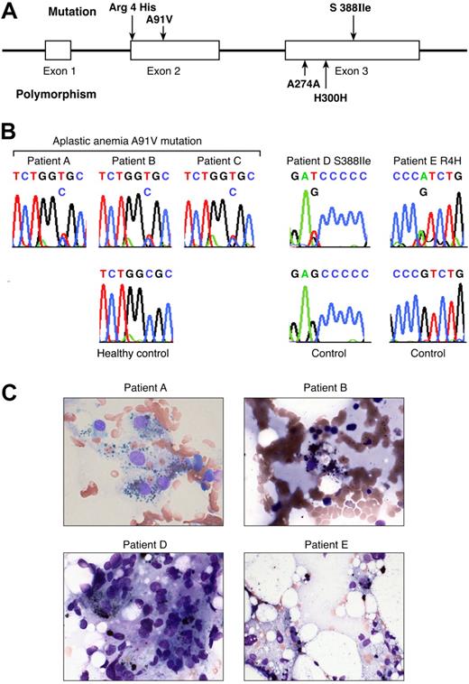 Figure 1. Perforin mutations in patients with aplastic anemia. (A) Linear structure of the PRF1 gene, which encodes the human perforin protein and aplastic anemia-associated mutations. The segments represent the exons. PRF1 has 3 exons, 2 of which (exons 2 and 3) contain coding sequences. In aplastic anemia, nonsynonymous mutations were found in exon 2 (codon 4 Arg/His and codon 91 Ala/Val) and exon 3 (codon 388 Ser/Ile). The polymorphisms in exon 3 are also shown (codons 274 and 300). R indicate arginine; H, histidine; I, isoleucine; V, valine; A, alanine. (B) Sequences of the patients carrying the mutations compared with sequences obtained from the controls. Green identifies adenine (A); red identifies thymidine (T); black identifies guanine (G); and blue identifies cytosine (C). (C) Bone marrow smear examination from the patients carrying PRF1 mutations. Four of 5 patients carrying mutations revealed hemophagocytosis in bone marrow at diagnosis.