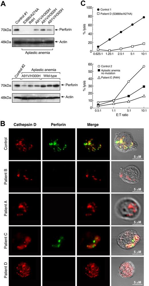 Figure 2. Decreased perforin protein levels and cytolytic activity in patients carrying PRF1 mutations. (A) Cytoplasmic extracts from T cells of patients with aplastic anemia with PRF1 mutations (n = 5) and healthy controls (n = 8) were analyzed for perforin protein expression by immunoblot. All 5 patients carrying PRF1 mutations revealed decreased or absent perforin protein levels. All samples were run side by side. The upper panel (from left to right) shows the perforin protein levels from a healthy person and patients D, E, A, B, and C. The lower panel shows the immunoblot results from chronologically different samples obtained from the same patients (from left to right a healthy control, patient C, patient A, and patient B, and 3 patients with no mutations). Patients without PRF1 mutations revealed perforin protein levels comparable to that from healthy volunteers. (B) Decreased perforin granules in cytotoxic cells from patients with aplastic anemia with PRF1 mutations. CD8+ T cells from patients carrying PRF1 mutations and healthy controls were double stained in parallel with anti-cathepsin D (red, first column) and anti-perforin (green, second column) antibodies in at least 3 different experiments. Perforin and cathepsin D showed the expected pattern of colocalization in cytotoxic granules of control cells. Staining of the patients' cytotoxic cells revealed complete absence of perforin granules in patients A, B, and D (Figure 4); patient C showed slightly decreased staining of perforin granules, but they were abnormal in size. (Differences between perforin protein levels and perforin granule staining in patients A, B, and C, who have the same PRF1 mutation may be explained by different genetic background or additional unshared genetic alterations). The frequency of cathepsin-D in CD8+ T cells was similar in patients' and controls' samples. (C) Decreased cytolytic activity in patients with aplastic anemia. Natural killer cells were isolated from patients D and E, and their killing efficiency was determined in a standard Cr51-release assay against K562 target cells in comparison to cells from healthy donors. Patients carrying PRF1 mutations showed markedly decreased cytolytic activity compared with controls. A patient (not carrying any mutation or polymorphism) also showed decreased cytolytic activity but not as low as that observed in the patients with PRF1 mutations.