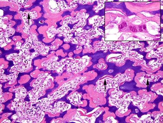 Photomicrograph of a bone biopsy from a patient with osteopetrosis, stained with haematoxylin-eosin. The amount of bone is markedly increased and represented by primary spongiosa (calcified cartilage rimmed by osteoid tissue). Note the numerous osteoclasts (arrows), laying along the trabeculae surface, without evidence of bone resorption (inset). Lacunae are obviously narrowed and the hematopoetic tissue reduced (courtesy of Professor F. Facchetti, Department of Pathology, University of Brescia, Italy).