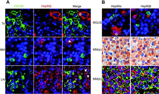 Figure 2. Hsp90α and Hsp90β proteins are strongly expressed in MM but not in MGUS or normal plasma cells. Immunohistochemical analysis of Hsp90α and Hsp90β protein expression in normal PCs (A) versus PCs from patients with MGUS or MM (B). Immunofluorescence images of sections of human tonsil (To), bone marrow (BM), and lymph node (LN) stained for CD138 (Cy-2, green), Hsp90β (Cy-3, red), and nuclei (DAPI, blue). CD138+ PCs of human tonsil and bone marrow express no Hsp90β, which is, however, expressed in ECs (*) and myeloblasts (Δ). Staining of lymph nodes shows strong Hsp90β expression in extrafollicular activated B cells (Δ) and weak expression in CD138+ PCs. The expression of Hsp90α was identical to that of Hsp90β (not shown). (B) Representative sections of BM biopsies from patients with MGUS (top panel) and MM (bottom panels 1 and 2). MGUS and MM(b) show staining for Hsp90α or Hsp90β (both with Cy-3, red) and CD138+ (Cy-2, green). Row MM(a) shows Hsp90α and Hsp90β expression staining using a secondary biotinylated antibody, a streptavidin/horseradish peroxidase complex, and 3,3 diaminobenzidine/H2O2 as the chromogen together with hematoxylin as the counterstain. PCs of MGUS express no Hsp90α and Hsp90β, which are, however, expressed in megakaryocytes (*). In contrast, Hsp90α and Hsp90β are strongly expressed in the cytoplasm of MM cells.