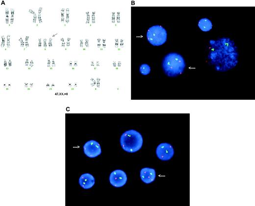 Figure 1. Cytogenetic analysis of bone marrow cells. (A) G-banding karyotype from a posttreatment (day 88) bone marrow cell showing 47,XX,+8 (arrow indicates trisomy 8). (B) FISH analysis in posttreatment (day 88) bone marrow using ETO (8q22, red; Vysis, Downer's Grove, IL) as a test probe for numerical study of chromosome 8, normalized to acute myeloid leukemia 1 (AML1; 21q22, green; Vysis) as an internal ploidy control probe showing 21.6% of the bone marrow interphase cells with 3 copies of chromosome 8 (arrows). FISH images were captured using a MAX-BX51 Olympus fluorescence microscope (Olympus, Tokyo, Japan) equipped with a 100×/1.30 numerical aperture oil objective. These images were captured and processed using MacProbe software (Applied Imaging, Santa Clara, CA). (C) FISH analysis of a pretreatment bone marrow sample showing trisomy 8 mosaicism. Arrows indicate trisomy 8 interphase nuclei.