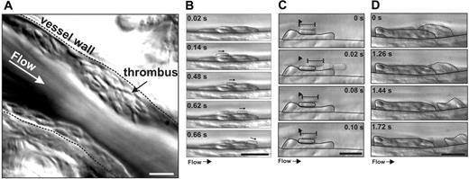 Figure 1. Dynamics of platelet thrombus formation in vivo. Mesenteric arterioles of rats were injured via photoactivation of systemically administered rose bengal, and platelet interactions with growing thrombi were visualized by DIC microscopy. (A) This single image (representative of 12) highlights the ability of this imaging technique to resolve single platelets during thrombus formation in vivo (see Video S2 for analysis of thrombus development in real time). (B) Representative example of a newly recruited platelet translocating over the thrombus surface with a sliding motion, maintaining maximal surface area contact (Video S2). (C) A single adherent platelet (dotted outline) extending and recoiling from a fixed point of contact over the surface of another stationary adherent platelet. Such behavior was often induced by transient contacts made with other translocating platelets (0.02 seconds, dotted outline) (Video S3). (D) Platelets within the superficial layer of thrombi were loosely packed such that platelets often detached from the thrombus surface in clusters (Video S2). White scale bar = 5 μM; black scale bar = 10 μM.