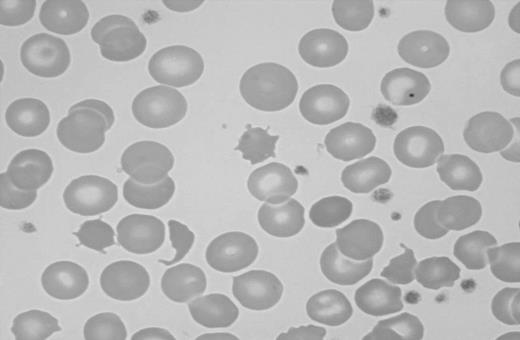 Figure 2. Blood smear showing characteristic findings of hyposplenism such as Howell-Jolly bodies, acanthocytes, and target cells. Image was observed using an Olympus Provis AX70 microscope equipped with an Olympus PlanApo 60 ×/1.40 numerical aperture oil objective (Olympus, Tokyo, Japan). Resolve high-viscosity immersion oil was used as imaging medium, and cells were stained with Wright-Giemsa. Image was acquired using a Nikon DXM 1200 digital camera and Nikon ACT-1 software version 2.62 (Nikon, Melville, NY).