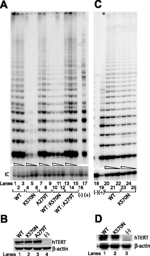 Figure 3. Telomerase enzymatic activities of additional naturally occurring hTERT variants as determined in VA13+hTERC cells or in primary cells. . / (A) Representative TRAP gels showing the relative telomerase enzymatic activities obtained from the substitution mutations and the wild-type hTERT constructs either individually transfected (lanes 1-9) or cotransfected (lanes 10-15). Serial 5-fold dilutions of the transfected cell lysates (indicated by triangles) were assayed for each sample to ensure linearity of the assay. Lanes 16 and 18 show negative controls composed of cell lysate denatured at 95°C for 5 minutes prior to assaying. Lanes 17 and 19 show PCR products amplified from the non-hTERC control TSR8 DNA template supplied in the TRAP kit. IC indicates PCR products amplified from an unrelated DNA template, which is included as an internal control for PCR amplification efficiency in each reaction. (B) Western blot of wild-type and various natural hTERT variants isolated from transfected cell lysates and probed with an anti-HA probe against the N-terminal HA tag at each of the hTERT constructs. (C) Telomerase enzymatic assay of cell lysates prepared from about 106 primary lymphocytes collected from a patient with the hTERT K570N variant (lanes 23-25) or a healthy age-matched individual (lanes 20-22). (D) Northern blot analysis of hTERT gene expression in lymphocytes of a patient with the hTERT K570N variant (lane 2), a healthy age-matched individual (lane 1), or in the VA13+hTERC cells (lane 3) that is known to lack hTERT gene expression.