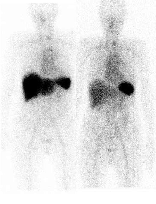 Figure 1. Serial 123I-labeled anterior whole-body SAP scintigraphy. Visceral amyloid deposits in the spleen and liver pretreatment (left) are shown. Six months after CTD treatment (right), which resulted in a complete clonal response, marked regression of amyloid from the liver was evident.