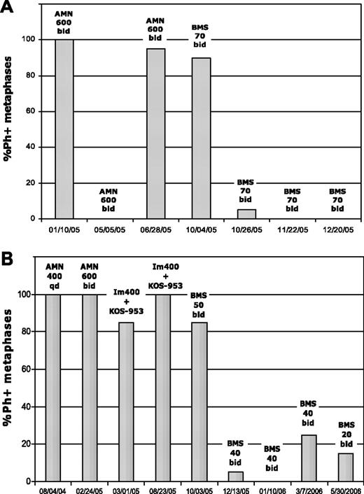 Figure 1. Complete cytogenetic response in 2 patients treated with dasatinib after imatinib and nilotinib failure. Patient A was in BP and harbored the P-loop mutant E255V/K. This patient was taken off the study in January 2006 to undergo bone marrow transplantation in complete cytogenetic response. Patient B was in accelerated phase and harbored the F359V mutation at dasatinib therapy. KOS-953 indicates the heat shock protein 90 inhibitor 17-allylamino-17-demethoxygeldanamycin (17-AAG); Im, imatinib; AMN, nilotinib; BMS, dasatinib; qd, daily; and bid, twice daily.