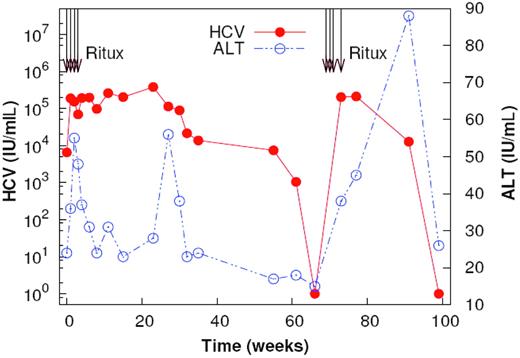 Figure 1. Plasma HCV RNA and ALT changes after rituximab infusions. Two courses of rituximab were given at week 0 and week 70. Plasma HCV RNA and ALT are shown. HCV RNA levels increase rapidly after the first dose of rituximab. Transient increases in ALT are observed at the initiation of treatment and with the reappearance of B cells.
