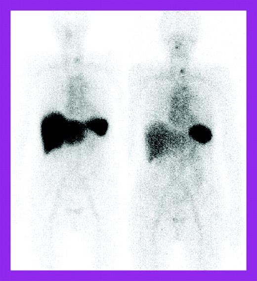 Serial 123I-labeled anterior whole-body SAP scintigraphy. See the complete figure in the article beginning on page 457.
