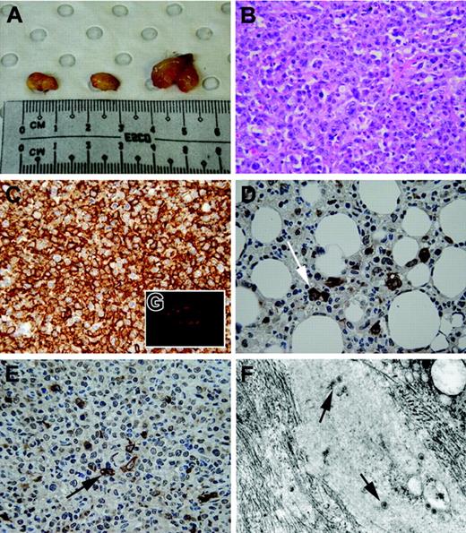 Figure 3. Macroscopic and histological appearance of EBV-induced tumors. (A) Typical appearance of intra-abdominal tumors in one NOD-SCID mouse at autopsy. Tumors were large (0.5-1.0 cm) and solid and contained necrotic foci on cross-section. (B) Histological appearance of tumors in NOD-SCID mice. On light microscopy, tumors were high-grade large-cell lymphomas with high mitotic rates, with varying degrees of tissue necrosis. (C) Immunohistochemical staining confirmed that all tumors were of B-cell origin (brown color indicates CD20+ cells; original magnification ×400). (D-E) Immunohistochemical staining of tumors for LMP-1 marker (brown staining; arrows) of EBV lymphoma in both extranodal (D) and nodal (E) regions. (F) Electron microscopy revealing presence of virus (arrows) within intra-abdominal tumor mass (original magnification ×45 000). (G) Immunofluorescent staining of tumors demonstrated the presence of PDCs (red fluorescence) within the tumor periphery using anti–human BDCA-2 mAbs. Images in panels B-E were taken with a 10×/0.30 NA objective; image in panel G was taken with a 40×/0.75 NA objective.
