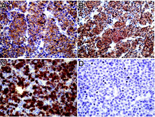 Figure 3. Strong expression of CT antigens in extramedullary myeloma using immunohistochemistry. Immunohistochemical staining of an extramedullary plasmocytoma (patient BMT47) with mAb M3H67 to MAGEA3 (A), mAb 57Bm to MAGEA4 (B), mAb E978 to NY-ESO-1 (C), and mAb CT10#5 to MAGE-C2/CT10 (D), diaminobenzidine chromogen. Primarily cytoplasmic expression of MAGEA3 and MAGEA4 in all tumor cells (A, B), mixed cytoplasmic and nuclear presence of NY-ESO-1 in a majority of plasmocytoma cells, and nuclear expression of CT10/MAGEC2 in single tumor cells.