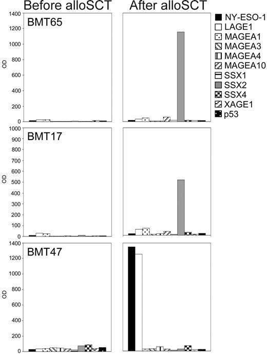 Figure 4. CT antigen–specific antibody responses in patients with multiple myeloma following allogeneic stem cell transplantation. Sera from patients with MM (n = 66) were screened for IgG antibodies against 3 CT antigens (MAGEA3, SSX2, NY-ESO-1) in an ELISA. Sera showing positive results were sent to the New York branch of the Ludwig Institute for Cancer Research for confirmation of the results using recombinant proteins of 10 different CT antigens (NY-ESO-1, LAGE1, MAGEA1, MAGEA3, MAGEA4, MAGEA10, SSX1, SSX2, SSX4, XAGE1) and p53 in an ELISA. Optical density (OD) results (serum dilution 1:100) of the ELISA are given for 3 representative antibody-positive patients with MM, with patients BMT65 and BMT17 showing high-titered antibodies against SSX2, and patient BMT47 showing a strong antibody response against NY-ESO-1 and its homologue LAGE following allogeneic stem cell transplantation. Importantly, pre–bone marrow transplantation samples of all patients who had undergone alloSCT were negative for CT antigen–specific IgG antibodies.