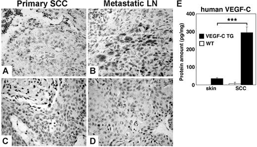 Figure 2. Transgenic VEGF-C expression is maintained during skin carcinogenesis. In situ hybridization demonstrates strong expression of human VEGFC mRNA in squamous-cell carcinomas (SCCs) of VEGF-C transgenic mice. (A) In primary tumors, SCC cells express high levels of VEGFC mRNA, as indicated by hybridization to an antisense human VEGFC probe. (B) In SCC metastases that form in sentinel lymph nodes (LNs), this expression of VEGF-C mRNA is maintained. (C-D) A human VEGF-C sense control probe did not hybridize with tumor samples. (A-D) Scale bars represent 100 μm. (E) ELISA analysis of human VEGF-C protein expression in skin and tumor lysates (n = 5 per group) revealed significant increases in the levels of VEGF-C protein in SCCs that form in VEGF-C transgenic mice, compared with the normal skin of these mice. No human VEGF was detected in skin or tumor lysates of control mice. Data are expressed as mean ± SD; ***P < .001.