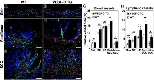 Figure 3. Increased tumor lymphangiogenesis and angiogenesis in VEGF-C transgenic mice. Immunofluorescence analyses of CD31 (green) and LYVE-1 (red) expression in normal skin (A-B), early papillomas (C-D), and SCCs (E-F) of control (WT; A,C,E) and VEGF-C transgenic (VEGFC TG; B,D,F) mice revealed increased vascularization of papillomas and SCCs in VEGF-C transgenic mice and in control mice, compared with their PMA-treated skin. Tumor lymphangiogenesis was more prominent in VEGFC transgenic mice (D,F) than in control mice (C,E), with increased numbers of enlarged lymphatic vessels (red). Slight increases in the amount of tumor angiogenesis (green) in SCCs of VEGFC transgenic mice (F) were also observed, compared with that of control mice (E). Nuclei are labeled blue (Hoechst stain). (A-F) Scale bars represent 200 μm. (G-H) Computer-assisted morphometric analysis of normal cutaneous vessels and of tumor-associated lymphatic and blood vessels was performed. A significant increase in the relative area occupied by blood vessels in the peritumoral area of SCCs (Peri SCC), as well as within SCCs (Intra SCC), was observed in VEGFC transgenic mice (TG; ▪), compared with that of the control mice (WT, □) (G). A significant increase of the relative area occupied by lymphatic vessels was observed in the VEGFC transgenic mice, throughout all stages of skin carcinogenesis (H). Skin indicates PMA-treated normal skin (n = 7); SP, small papillomas (1-3 mm; n = 6); LP, large papillomas (> 3 mm; n = 6); and SCC, squamous-cell carcinoma (n = 7). Data are expressed as mean ± SEM. *P < .05; **P < .01; ***P < .001; NS = not significant.