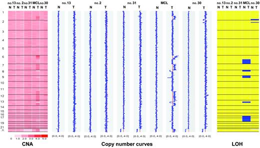 Figure 1. Matched-pair analysis of tumor cells and buccal swabs from 4 patients with CLL and one patient with MCL. Chromosomes are separated by vertical lines and numbered on the left. Normal (N) and tumor (T) cells are represented in separate columns. Left panel: copy number values (CNA). Inferred copy numbers are displayed in a color-code from 0 to 5. Middle panel: copy number plot. Copy numbers are displayed from 0 to 4. The red line indicates a normal diploid copy number of 2. Right panel: LOH plot. Yellow color means retention and blue color, LOH. In the MCL sample, chromosomes 6q, 17, and 18 show complete uniparental disomy (UPD) with normal copy number.