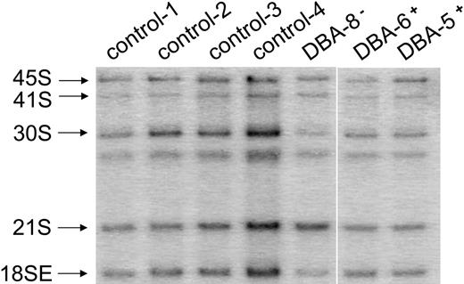 Figure 6. Northern blot analysis displays defective pre-rRNA processing in CD34+ cells from patients with DBA who have mutations in RPS19. The figure shows a representative Northern blot using total RNA isolated from CD34+ cells and prepared for Northern blot analysis as described in Figure 2. Pre-rRNAs were hybridized with oligonucleotide γ (Figure 1) to examine the ratio of 21S to 18SE pre-rRNA.