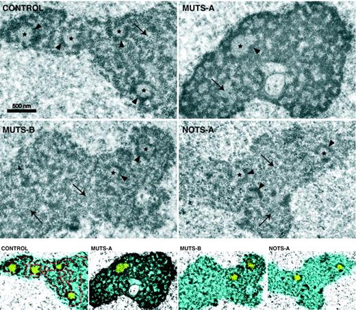 Figure 7. Visualization of nucleolar organization in DBA fibroblasts by electron microscopy. The 3 nucleolar components classically described are visible in control cells: fibrillar centers (stars), the meshwork of the highly contrasted dense fibrillar component (arrowheads) and, in between, the granular component (arrows). The dense fibrillar component appears abnormally compact and reticulated in MUTS-A cells, whereas it is scarce and disorganized in NOTS-A cells. Contrast enhancement and colors were applied to stress the differences in nucleolar organization (bottom): nucleolus in blue with fibrillar centers in yellow. The highly contrasted dense fibrillar component is highlighted in red in control cells. The nucleolus appears less fibrillar and more granular in NOTS-A and MUTS-B cells.