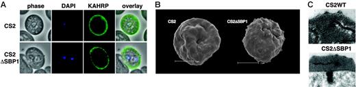 Figure 3. KAHRP is trafficked normally to the erythrocyte membrane and assembled into knob structures. (A) Immunofluorescence assay to determine the localization of KAHRP in parental CS2 (top) and CS2ΔSBP1-infected erythrocytes (bottom). Cells were reacted with anti-KAHRP antibodies and identical localization patterns for both parasite lines were observed. (B) Scanning electron microscopy revealed typical knob structures in CS2ΔSBP1 parasite-infected erythrocytes compared with parental CS2. The panel shows a representative trophozoite-infected erythrocyte of each cell line. The bar represents 2 μm. (C) Ultrastructural analysis of CS2- and CS2ΔSBP1-infected cells of knob structures (arrow).