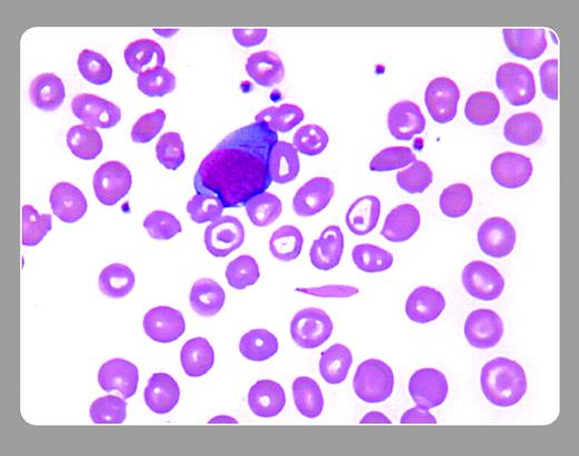 A 66-year-old African American woman with lifelong anemia and a positive family history of anemia came to the emergency room with abdominal pain. Her numerous previous medical problems included intermittent bone pains, infections, and chest pains. When seen, she was writhing in pain and asking for narcotics. Her physical exam showed slight fever, some scleral icterus, and a tender abdomen with normal bowel sounds. . / The clinical picture was thought to be consistent with sickle cell painful crisis, but the white blood cell count was 3.7 × 109/L; granulocyte count, 1.0 × 109/L; and platelet count, 110 × 109/L. In retrospect, granulocytopenia and thrombocytopenia had been evolving over the past several months. A peripheral smear showed sickle forms and targets. Immature cells were also present, some of which contained Auer rods (see above). The bone marrow was hypocellular with megaloblastic changes, but with 15 % leukemic cells. Rather than another diagnosis of painful crisis, she had refractory anemia with excess blasts in transformation (RAEB-T).
