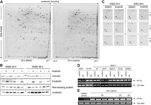 Figure 1. Two-dimensional gel analysis of proteins from K562 cells. (A) Protein profiles of extracts from K562 cells incubated with DMSO (left) or with imatinib (right) for 24 hours. The marked protein spots were chosen for further characterization by MALDI-MS and ESI-MS/MS because they were expressed to elevated relative levels either in control cells (left) or in cells after imatinib treatment (right). (B) Immunoblots of some representative proteins to confirm the results of 2-D gels. Expression of vinculin and Ran-binding protein was down-regulated, and expression of β-tubulin was up-regulated in K562 cells after incubation with imatinib for 24 and 48 hours. Normalization was performed using α-tubulin. (C) Enlarged regions of Coomassie-stained 2-D gels. Arrows indicate the location of eIF5A. (D) RT-PCR for the detection of eIF5A expression in K562, HL-60, and BA/F3p210, including the mutants M351T, T315I, and E255K as well as wt-BA/F3 cells. Cells were incubated with imatinib for 24 hours and compared with untreated control. (E) RT-PCR for the detection of eIF5A mRNA levels in PBMCs from 2 healthy donors and 7 CML patients. Normalization was performed with human 18S rRNA.