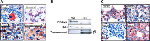 Figure 7. Cytoplasmic localization of phosphorylated Stat5 in myeloid leukemia. (A) Immunohistochemical detection of P-Y-Stat5 in neoplastic cells from patients with CML. P-Y-Stat5 immunostaining was realized on normal bone marrow (BM), on neoplastic cells from CML in chronic phase (CML-cp), in blast phase (CML-pb), and in megakaryoblast crisis. (B) Cytoplasmic and nuclear extracts were prepared from leukemic cells of a patient with CML and analyzed by Western blot with the indicated antibodies. (C) Immunohistochemical detection of P-Y-Stat5 in AML blasts. P-Y-Stat5 immunostaining was performed with bone marrow sections from patients AML-M2, -M3, -M6, and -M7.