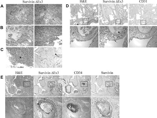 Figure 1. Immunolocalization of Survivin ΔEx3 in brain tumors and angiomas. Formalin-fixed paraffin-embedded tissues were immunostained with antibodies against Survivin, Survivin ΔEx3, CD31, or CD34. Survivin ΔEx3 localized to the vascular endothelium of the brain tumor (A-B) and angioma tissues (C-E arrowhead). Vascular endothelial cells staining positive for Survivin ΔEx3 were also positive for CD31 (D) and CD34 (E). Survivin ΔEx3 was not visualized within the lymphatic endothelium (D, arrow). Survivin was not detected in angioma tissues (E). The tissues represented include (A) medulloblastoma, (B) ependymoma, (C) capillary venous angioma, (D) lymphangioma, and (E) pyogenic granuloma.