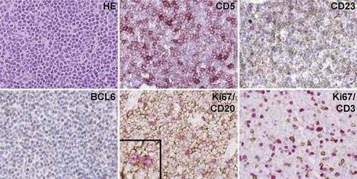 Figure 1. Histology of lymph node infiltrated by B-CLL cells. Ubiquitously present B-CLL cells were positive for CD23 and CD5. Scattered CD3+ T cells were present throughout the LN. The absence of clusters of BCL-6+ cells excluded the presence of germinal center remnants in the LNs. Ki67/CD20 and Ki67/CD3 double staining indicate that the majority of cycling Ki67+ cells (pink) were also CD20+ (brown) (see inset), whereas the CD3+ T cells were predominantly Ki67 negative. Magnification ×40.