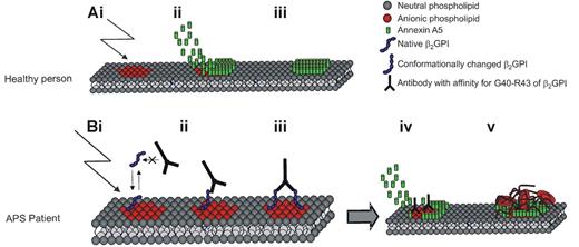Figure 2. Model for a mechanism of anxA5 reduction on the surface of phospholipid membranes leading to thrombosis in APS. Panel Ai shows anionic phospholipids exposed at the surface of endothelial cells and platelets after activation/damage of or to the cells. Subsequently AnxA5 becomes positioned above the damaged site and thereby prevents further clotting (panels Aii and Aiii). Monomeric β2GPI does not have a sufficient affinity to compete with AnxA5 for binding. When damage occurs to the endothelial surface of an APS patient with antibodies against epitope G40-R43 on domain I of β2GPI, β2GPI initially binds the anionic phospholipids with a rather low affinity (panel Bi). However, following binding, β2GPI undergoes a conformational change that enables the antibody to bind the epitope g40-R43 of 2 β2GPI molecules (panels Bii and Biii). This dimerized β2GPI has a high affinity for the anionic phospholipids at the surface of the damaged cell.21 Panel Biv shows that due to the dimerization of β2GPI, it has a high enough affinity to compete with AnxA5 for the exposed anionic phospholipids. The reduced AnxA5 concentration on the damaged cell may lead to excessive clotting (panel Bv) and subsequently thrombosis.