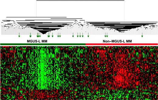 Figure 7. MGUS-L signature is present in most PCs of patients still alive more than 10 years after TT1. As in Figure 2, a 2-dimensional unsupervised hierarchical cluster analysis of 52 genes (rows) in CD138-enriched plasma cells from patients with MGUS (n = 56), MM from MGUS (n = 16), and newly diagnosed MM (n = 351, training cohort) and from 20 long-term survivors (columns). Long-term survivor samples are indicated by green arrows.