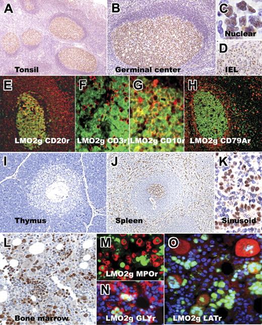 Figure 2. Immunohistochemical staining for LMO2 in normal hematopoietic tissue. Low- and high-magnification images of normal tonsil sections show LMO2-specific staining within germinal centers; LMO2 staining is localized to the nucleus and is also found in intraepithelial lymphocytes (IELs) within the tonsil epithelium. Double-immunofluorescence labeling on tonsil tissue shows colocalization of LMO2 staining (green nuclear stain in all panels) with CD20 (red, membrane), CD3 (red, membrane/cytoplasmic), CD10 (red, membrane), and CD79a (red, cytoplasmic) staining in germinal-center cells. CD79a+ plasma cells lack LMO2 staining. Normal thymus shows rare, scattered LMO2-positive cells in the cortex and medulla. Normal spleen shows LMO2-specific staining in germinal centers of secondary lymphoid follicles and sinusoidal lining cells, whereas the mantle and marginal zones lack staining. The bone marrow shows LMO2 staining in subsets of immature myeloid (MPO-positive, red) and erythroid (glycophorin-positive, red) precursors and in megakaryocytes (LAT-positive, red). Red immunofluorescence is indicated by r; green immunofluorescence, by g.