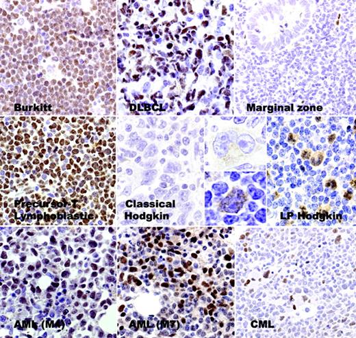 Figure 3. Immunohistologic staining for LMO2 in hematolymphoid neoplasia. Representative examples of LMO2 immunostaining in lymphomas show LMO2 expression in Burkitt, DLBCL, precursor T-acute lymphoblastic lymphoma, and lymphocyte-predominant (LP) Hodgkin lymphoma, whereas it is absent in extranodal marginal-zone lymphoma and classical Hodgkin lymphoma. Among leukemias, immature blasts in an example of acute myeloid leukemia (AML; M4) and acute megakaryoblastic leukemia (AML; M7) show LMO2 staining. A case of chronic myeloid leukemia (CML) shows LMO2 staining in micromegakaryocytes and in a subset of early myeloid precursors but not in mature neutrophils.