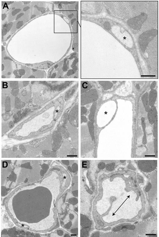 Figure 5. Expanded vacuoles and intussusception in male β3-null coronary capillaries. Transmission electron micrographs show that coronary capillaries from male β3-null mice contain single endothelial cells with expanded vacuoles (A-D) that, like pockets formed by interacting filopodia, are consistent with angiogenesis by division of existing vessels. Some vessels have a limited luminal area and appear to be composed of a single endothelial cell (B), because cell-cell junctions are not visible. Although less frequent, some endothelial cells have luminal processes that extend across the lumen, resembling angiogenesis by intussusception (E). Asterisks indicate expanded vacuoles; arrows, intussusception. Bar = 500 nm.