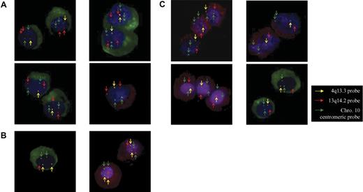 Figure 4. Representative examples of 4q13.3 and 13q14.2 aberrations by cIg-FISH. The clonal PCs in all cases are identified by cytoplasmic immunofluorescence staining of κ light chain (green, FITC) or λ light chain (red, PE). The images in the left column are MGUS cases (n = 5) while those in the right column are MM cases (n = 5). Yellow arrows indicate signals by the 4q13.3 region-specific probe (yellow); red arrows, signals by the 13q14.3 region-specific probe (red); and green arrows, signals by the chromosome 10 centromeric reference probe (green). (A) Four representative cases with copy number loss in 4q13.3 (1 yellow) but not 13q14.2 (2 red). (B) Two representative cases with copy number loss in 13q14.2 (1 red) but not 4q13.3 (2 yellow). (C) Four representative cases with copy number losses in both 4q13.3 (1 yellow) and 13q14.2 (1 red). Images were visualized using a Zeiss Axioplan 2 fluorescence microscope equipped with a charge-coupled device camera and a 40×/0.75 numerical aperture oil objective lens. Images were processed using ISIS3 software (MetaSystems).
