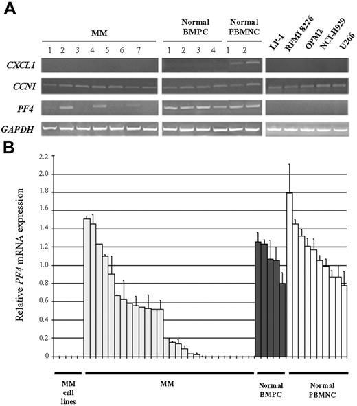 Figure 5. Messenger RNA expression of candidate genes of chromosome 4q in primary MM and MM cell lines relative to normal BM plasma cells (BMPCs) and PB mononuclear cells (PBMNCs). (A) Electrophoretic analysis of RT-PCR products shows representative transcript expression of CXCL1, CCNI, and PF4 in MM (cases 1 to 7), normal BMPCs (cases 1 to 4), normal PBMNCs (cases 1 to 2), and MM cell lines (RPMI-8226, LP-1, OPM-2, NCI-H929, and U-266). Nonexpression of CXCL1 is found in normal BMPCs, primary MM, and MM cell lines, and expression of CCNI is observed in all MM and normal samples. Conversely, down-regulation of MM primary samples and negligible expression of PF4 in MM cell lines are observed when compared with expressions in normal BMPCs and PBMNCs. GAPDH expression is displayed for normalization and mRNA quality control. (B) Quantitative RT-PCR shows down-regulation of PF4 in MM and MM cell lines (RPMI-8226, LP-1, OPM-2, NCI-H929, and U-266) relative to normal BMPCs and PBMNCs. The mean and range of fold changes are as follows: MM cell lines, not detected; MM, 0.41, 0 to 1.51; normal BMPCs, 1.08, 0.80 to 1.26; and normal PBMNCs, 1.15, 0.78 to 1.79. Expression level of less than 0.5 (dotted line) is classified as down-regulation. Gene expression is normalized by transcript expression of ACTB. Error bars represent SD.
