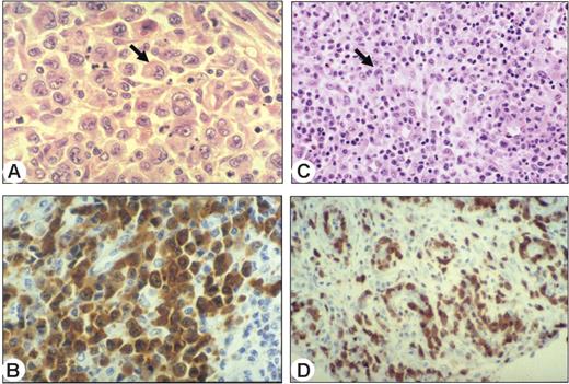 Figure 2. Morphologic variants and ALK staining illustrating 2 representative ALCL belonging to clusters C1 and C2, revealed by unsupervised analysis. (A) Common type ALCL (cluster C1) consists of large cells, including hallmark cells with a horseshoe shaped nucleus (arrow). Hematoxylin and eosin staining, magnified 1000 ×. (B) All malignant cells were strongly positive for ALK. Immunoperoxidase staining, magnified 1000 ×. (C) Small cell variant (cluster C2) with a predominant population of small cells with irregular nuclei, and scattered hallmark cells (arrow). Hematoxylin and eosin staining, magnified 400 ×. (D) Most of these cases are associated with a perivascular disposition of neoplastic cells highlighted by ALK staining. Immunoperoxidase staining, magnified 400 ×. Images were captured using a Leica DMR microscope equipped with an HC PL Fluotar 40×/0.85 numerical aperture (NA) or 100×/1.30 NA oil objective lens (Leica, Solms, Germany) and a Leica DFC 300 Fx camera. Images were processed using Leica IM50 image acquisition software.