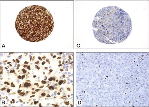 Figure 3. Immunohistochemical validation of some overexpressed genes using tissue microarrays. Immunostaining of 2 representative cases of ALK+ (A-B) and ALK− (C-D) ALCL. Malignant cells in the ALK+ patient strongly express C/EBPβ (A-B). Immunoperoxidase staining, magnified 50 × and 1000 ×. In the patient negative for ALK protein, only reactive histiocytes show strong nuclear staining (C-D). Immunoperoxidase staining, magnified 50 × and 400 ×. Images were captured and processed as described in Figure 2, except that an HC PL Fluotar 5×/0.15 NA objective was used for panels A and C.