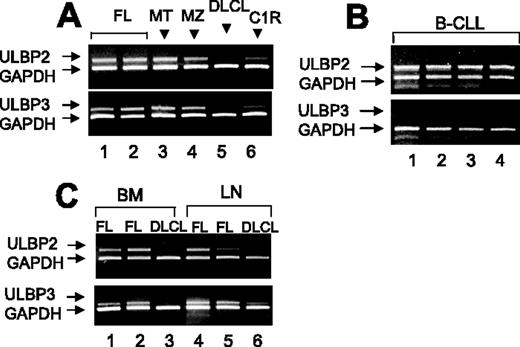 Figure 1. Transcription of ULBP2 and ULBP3 in B cells from NHL patients. Total RNA from B cells purified from PB (A-B) or BM or LNs (C) was reverse transcribed and amplified by PCR with specific primers for ULBPs compared to GAPDH. (A-C) ULBP2 and ULBP3 mRNA expression in purified PB B cells from (A) MT or MZ (1 representative case of 4 studied) or FL lymphomas (2 representative cases of 15 analyzed) or DLCL (1 representative case of 4), (B) B-CLL (4 representative cases of 10), and (C) BM- or LN-derived B cells from 2 FL lymphomas and one DLCL.