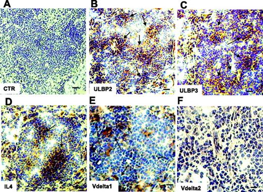 Figure 5. Expression of ULBP2, ULBP3, and IL-4 and localization of Vδ1 T cells in NHL in situ. Thin sections (5 μm) from frozen LNs of 6 FL NHL patients were immunostained with anti-ULBP2 (B), anti-ULBP3 (C), anti–IL-4 (D), or anti-Vδ1 (E) or anti-Vδ2 (F) mAbs, all at 5 μg/mL, followed by the peroxidase revelation system and counterstained with hematoxylin. Panel A is a negative control, an isotypic unrelated antibody (CTR). Arrows in panels B-E indicate positive cells. Slides were cover-slipped and analyzed under a IX70 microscope, equipped with a CCD camera, at ×20 magnification (A-D, bar represents 40 μm), or at ×40 magnification (E-F, bar represents 20 μm). Images were captured with Olympus Plan APO 20×/0.40 NA (A-D) or Olympus UAPO 40×/1.35 NA oil objectives. The total magnification was 200× or 400× according to the 20× or 40× objective used. Images were taken with CELL Olympic Biosystem imaging software version 2.0.