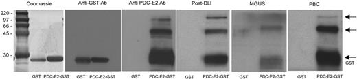 Figure 1. Reactivity of patient serum with PDC-E2 demonstrated by Western blot. Purified recombinant PDC-E2–GST or GST proteins were loaded in different lanes and probed with patient serum at 1:500 dilution. Antibodies against GST or PDC-E2 were used as a control. Arrows indicate protein fragments recognized by anti–PDC-E2 antibody.