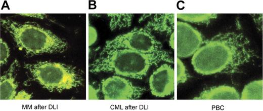 Figure 2. Indirect immunofluorescence analysis. Sera from MM after DLI (A), CML after DLI (B), and PBC (C) were diluted 1:40 in PBS and applied to human Hep-2 slides. FITC-conjugated secondary antibodies were used as detectors. All slides display the characteristic antimitochondrial immunofluorescence pattern.